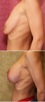 fonte poitrine menopause