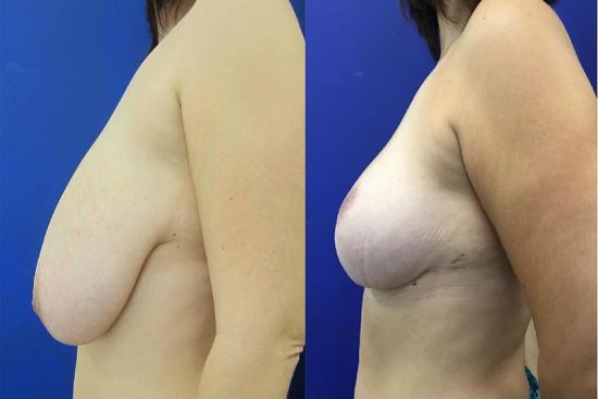 lifting-seins-turquie