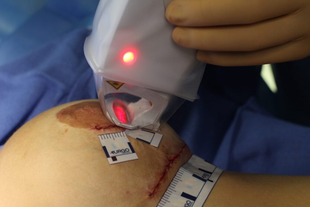 traitement-cicatrices-chirurgie-mammaires-laser
