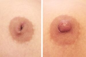resultat-correction-mamelons-ombiliques