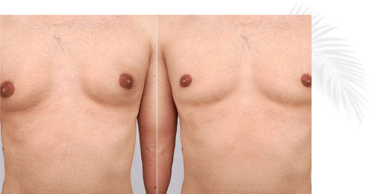 resultat-gynecomastie